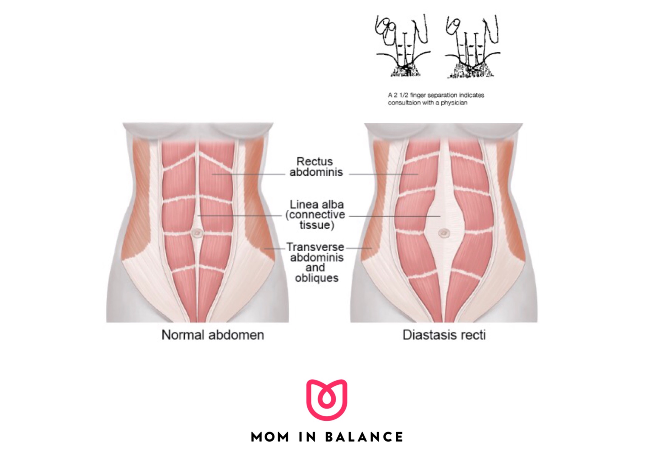 Everyting you want (need) to know about the diastasis